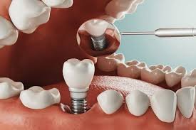 Microscope Precision Dentistry
